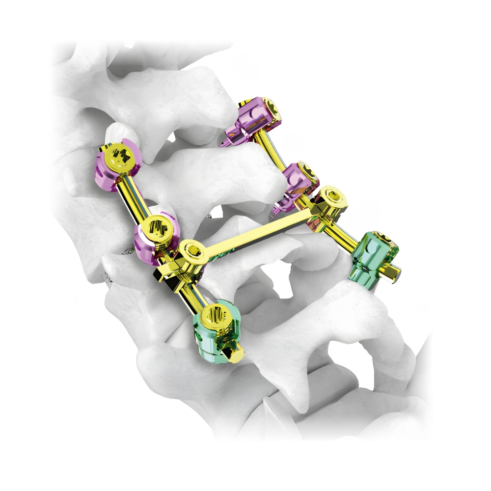 Image of MS MIS pedicle screw system cemented.